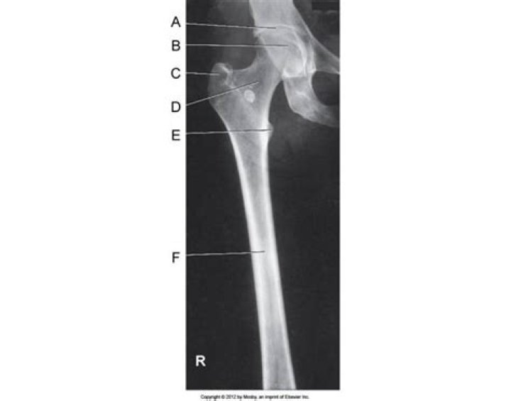 AP Femur Radiograph Quiz