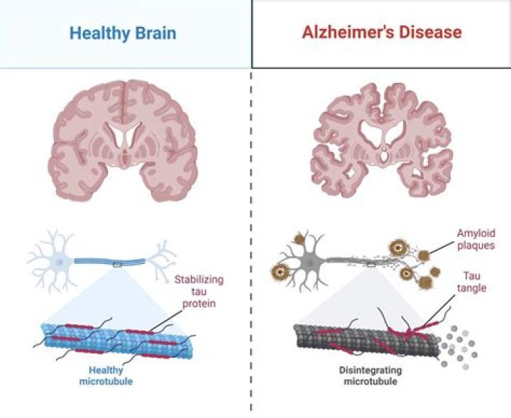 Does Alzheimer's skip a generation?