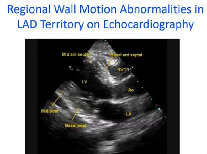 Echocardiography LV Wall Segment ID Quiz