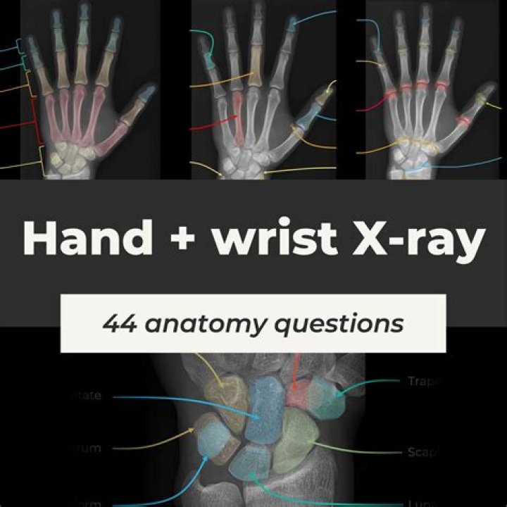 hand xray anatomy Quiz